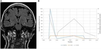 Case report: Seropositive myasthenia gravis complicated by limbic encephalitis positive for antibodies to AMPAR and Lgi1